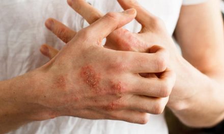 What does atopic skin mean? Atopic dermatitis