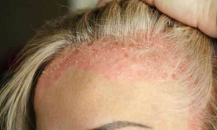 How does eczema go on hair?