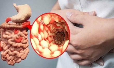 Symptoms and treatment of Crohn’s disease