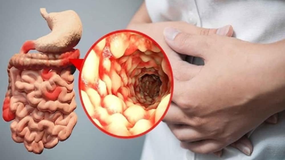 Symptoms and treatment of Crohn’s disease