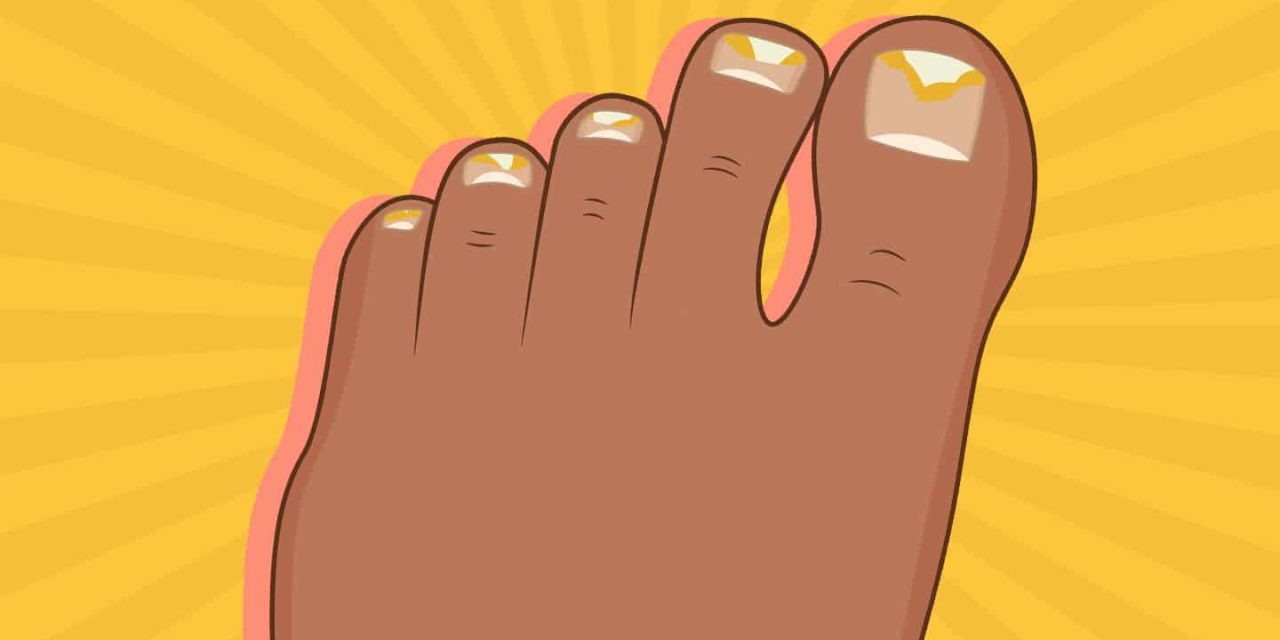 How does the foot fungus pass? Nail Mushroom Symptoms