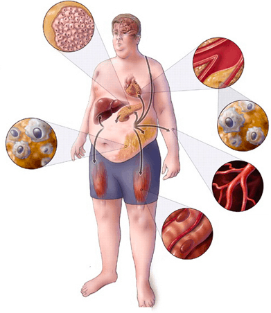 What is metabolic syndrome? What are the symptoms?
