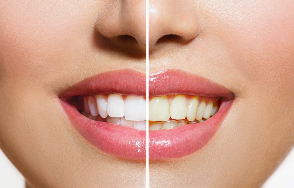 Teeth whitening is it possible with natural methods at home?