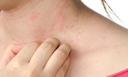 What triggers eczema? Foods that trigger eczema