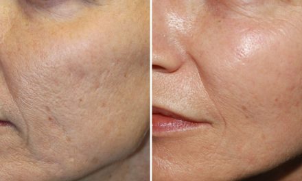 What is Dermapen and Mesotherapy difference?